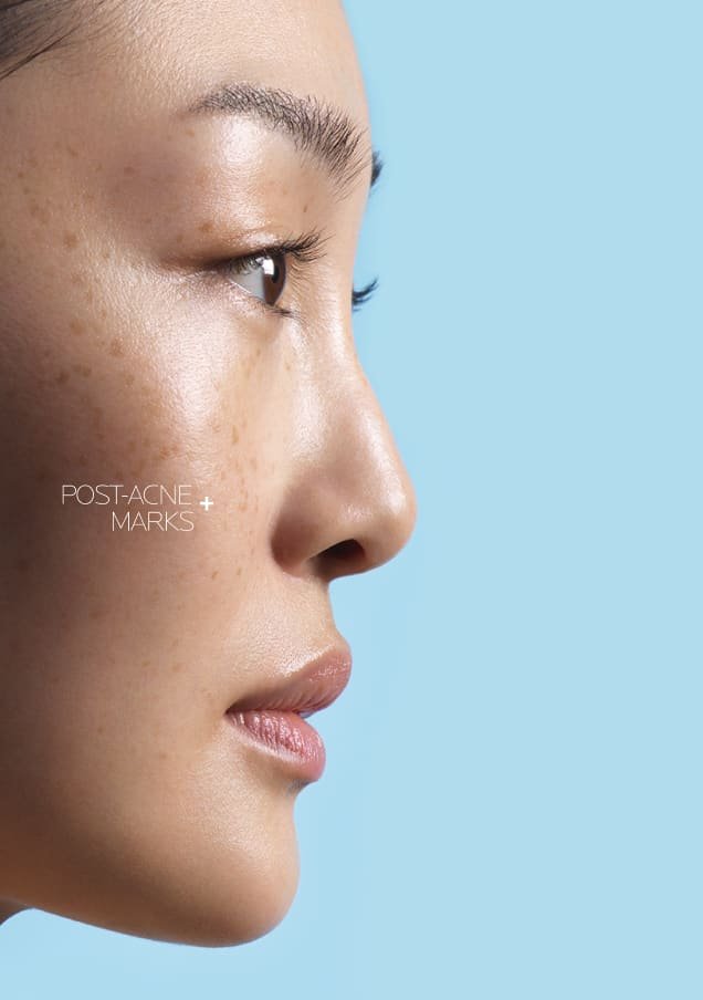 /-/media/project/loreal/brand-sites/lrp/emea/tr/products/effaclar/effaclar-az-cream/lrp-effaclar_azcream_flip_card_front_desktop_3.jpg