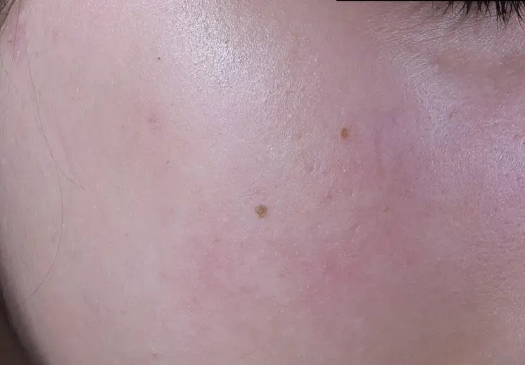 lrp_skin_effaclar_duom-before-after-after-1