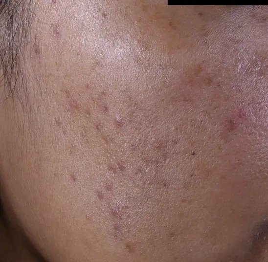 lrp_skin_effaclar_duom-before-after-after-2