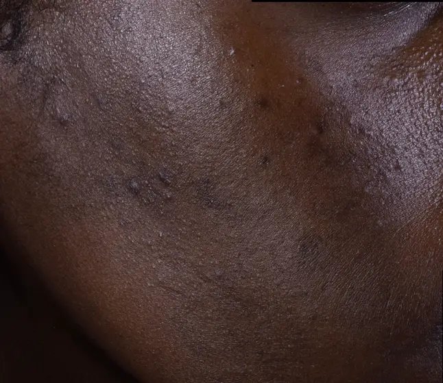 lrp_skin_effaclar_duom-before-after-after-3