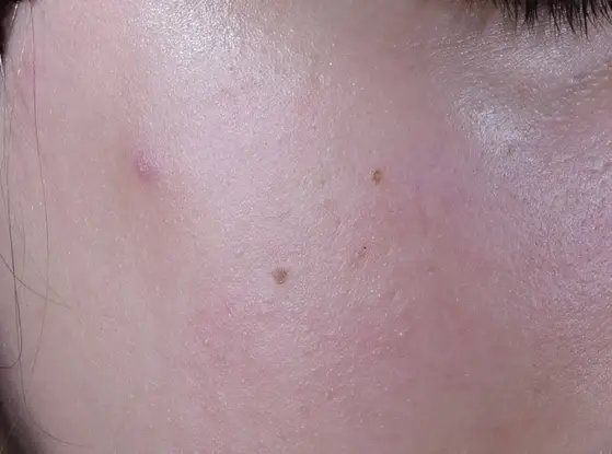 lrp_skin_effaclar_duom-before-after-before-1