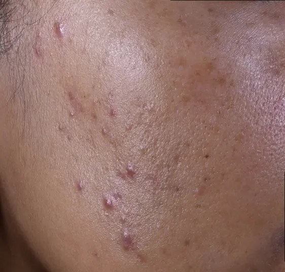 lrp_skin_effaclar_duom-before-after-before-2