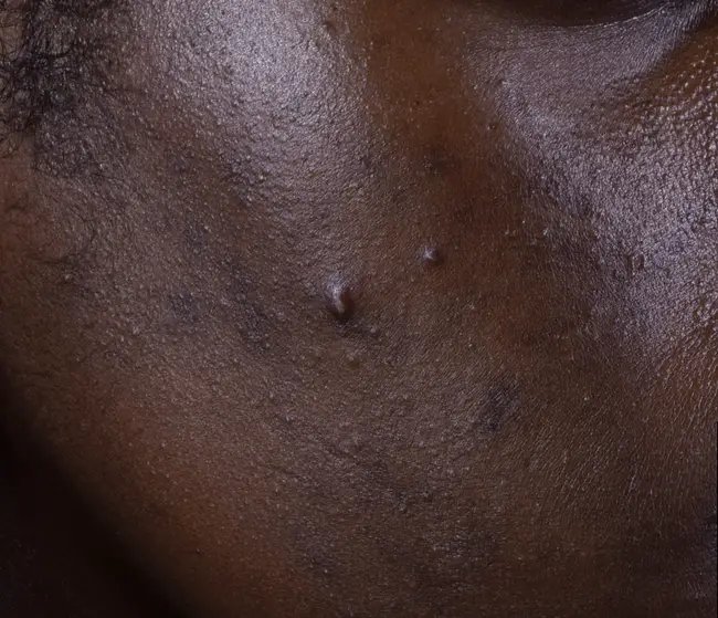 lrp_skin_effaclar_duom-before-after-before-3_1