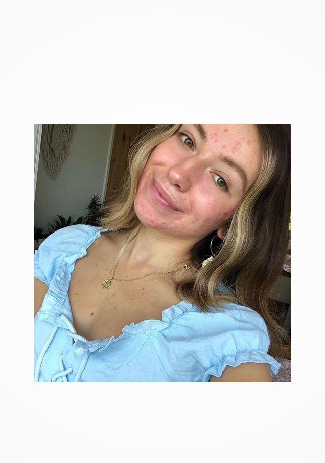 https://www.laroche-posay.com.tr/-/media/project/loreal/brand-sites/lrp/emea/tr/simple-page/landing-page/brand-campaign/instagram_1.jpg
