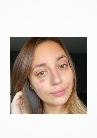 https://www.laroche-posay.com.tr/-/media/project/loreal/brand-sites/lrp/emea/tr/simple-page/landing-page/brand-campaign/instagram_3.jpg